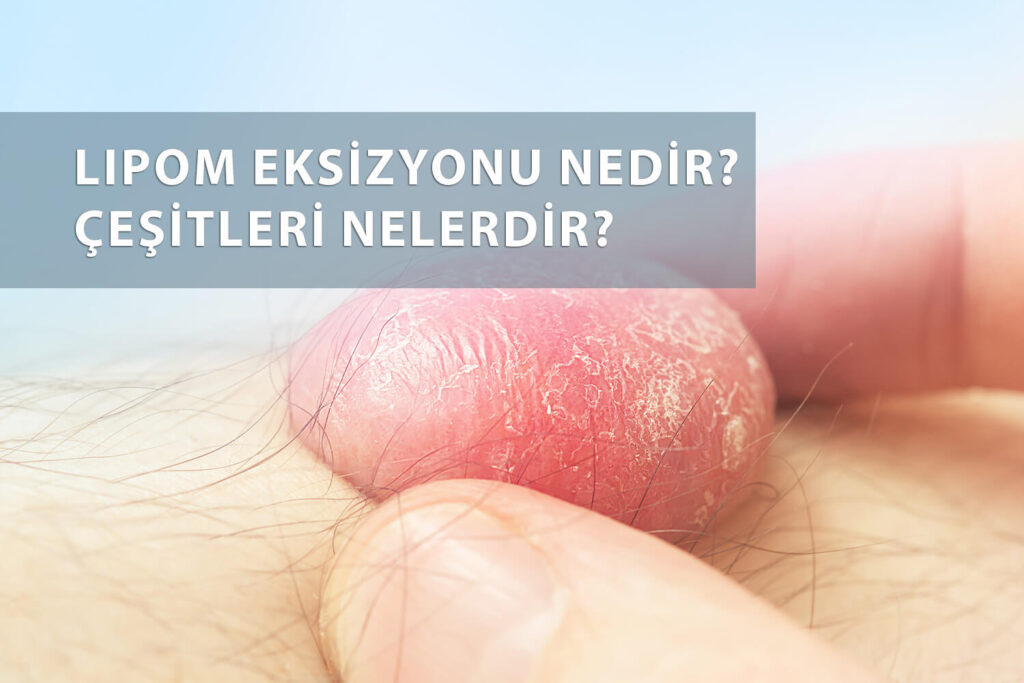 Lipom eksizyonu nedir, nasıl yapılır