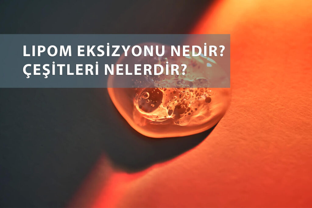 Lipom eksizyonu nedir, çeşitleri nelerdir